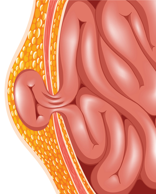 Source: Thinkstock/ blueringmedia, Hernia, IBS Symptoms, Intestinal Issues, Signs Of Hernia