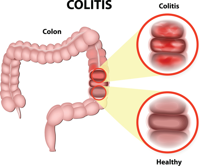 colitis symptoms, colitis treatments, colitis, colon