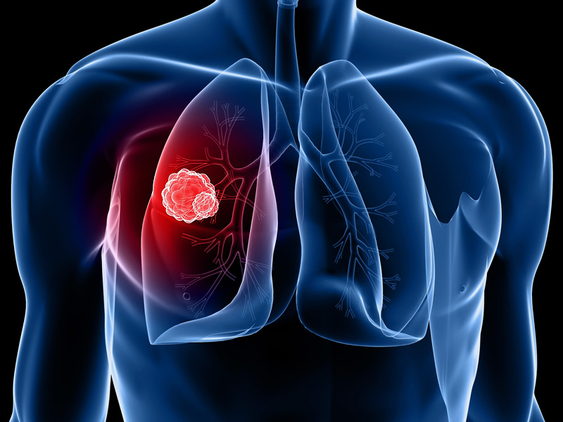 lung cancer, symptoms of lung cancer