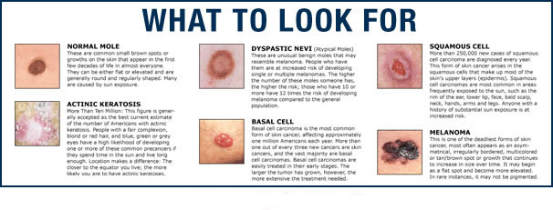 types of skin cancer, metastatic melanoma, skin cancer, stage 4 melanoma