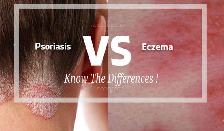 Eczema Vs Psoriasis