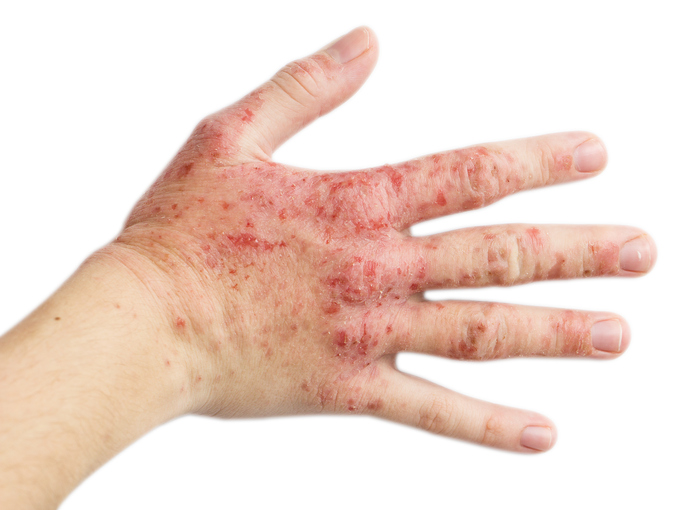 The problem with many people - eczema on hand. Isolated background, plaque psoriasis treatments