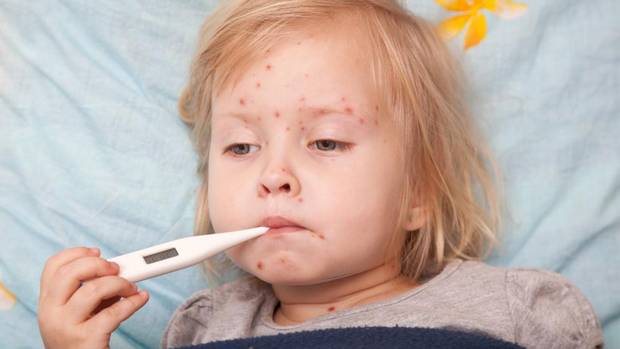 chicken pox, shingles, signs, symptoms, causes