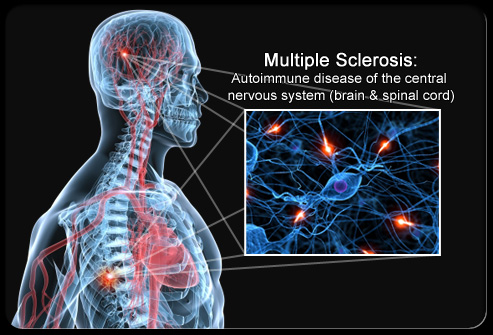 multiple-sclerosis-s1-brain-spinal-cord-nerves, ms, multiple sclerosis, ms treatments, ms alternative treatments