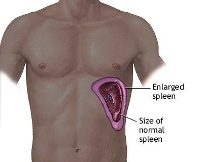 Spleen-Pain-6, enlarged spleen, spleen pain relief, spleen pain