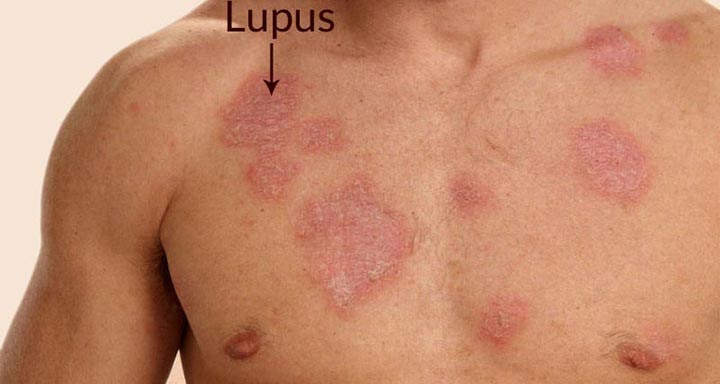 12 Early Symptoms and Signs You Have Lupus