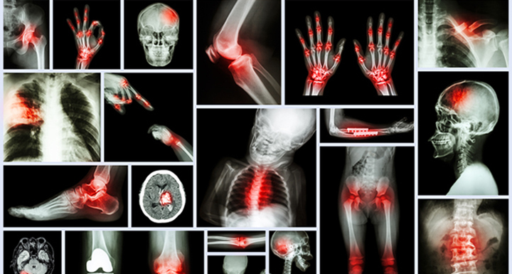 Arthritis: Critical Information