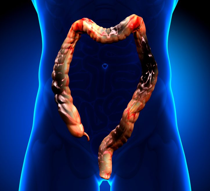The Causes of Colon Cancer