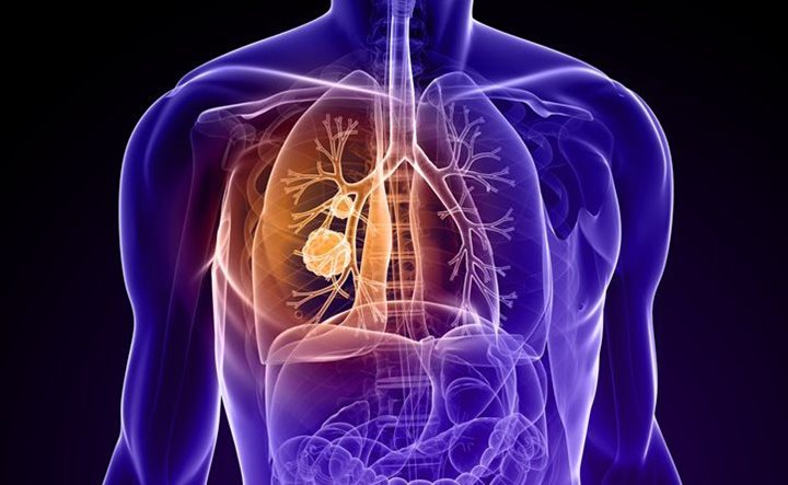 Lung Cancer Survival Rates And Life Expectancy