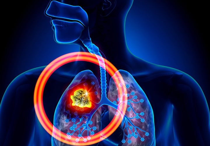 Symptoms, Causes and Treatments of Lung Cancer