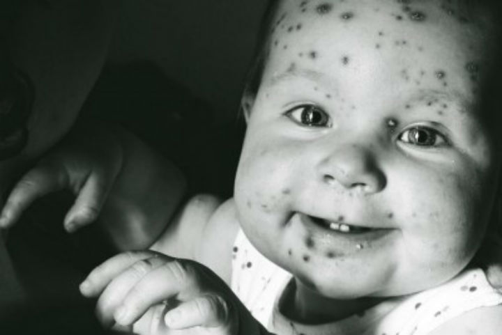 What You Need To Know About Chickenpox and Shingles