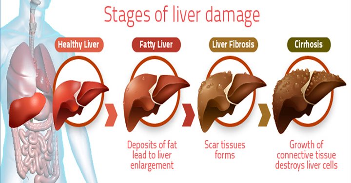 The 5 Stages of Liver Cirrhosis