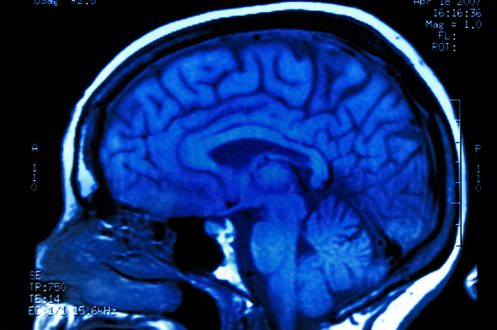 Brain Cancer: What is it?