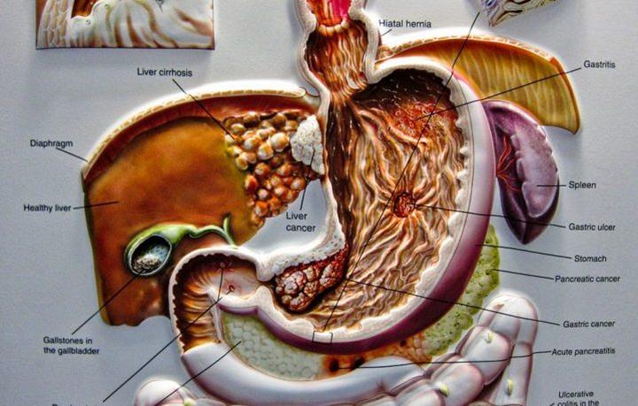 What Are the Stages of Pancreatic Cancer?