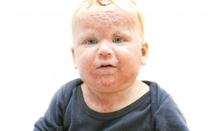 atopic dermatitis eczema