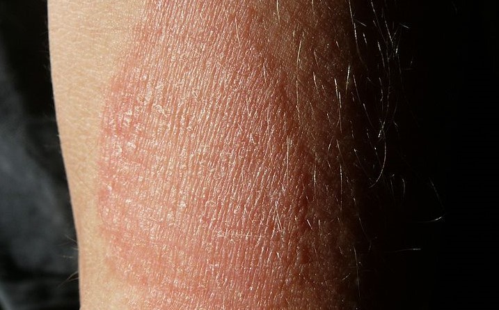 eczema treatments