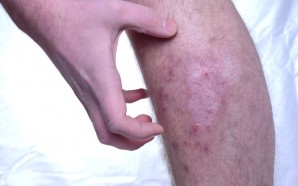 chronic atopic dermatitis treatment