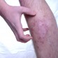 chronic atopic dermatitis treatment