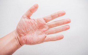 atopic dermatitis hand
