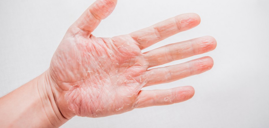 atopic dermatitis hand